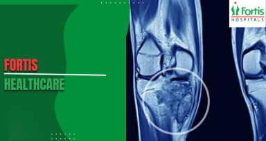 Osteosarcoma Causes
