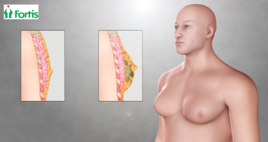 पुरुषों में बढ़े हुए स्तन - Gynecomastia