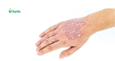 Symptoms of Psoriasis