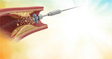 Understanding the Role of Rotablators