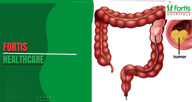 Stage III Rectal Adenocarcinoma