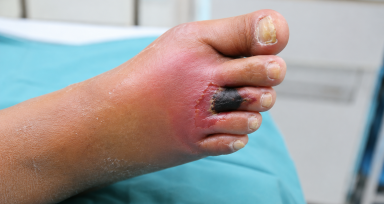 Diabetic Foot Infections