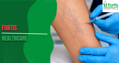 Sclerotherapy for Varicose Veins