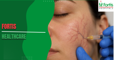 Sclerotherapy for Facial Veins