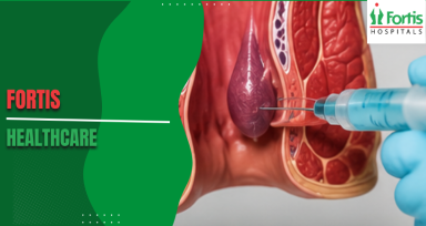 Treating Hemorrhoids with Sclerotherapy