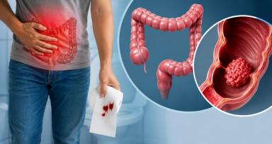 Blood in Stool: When Is It a Warning Sign of GI Cancer? - Dr Pradeep Jain