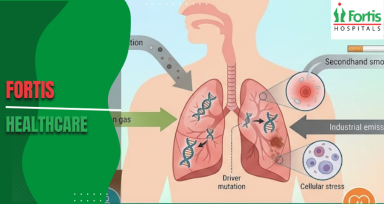 Lung Cancer 