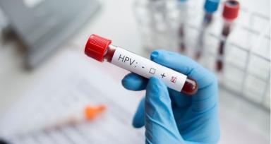 HPV-Positive vs HPV-Negative Head and Neck Cancer