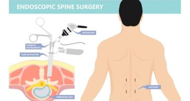 What Is Endoscopic Spine Surgery