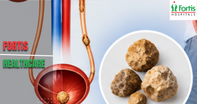 Kidney Stones Treatment