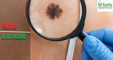 Melanoma Prevention and Treatment