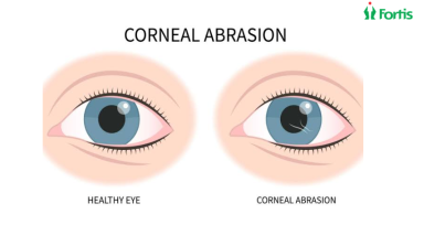 Corneal Abrasion