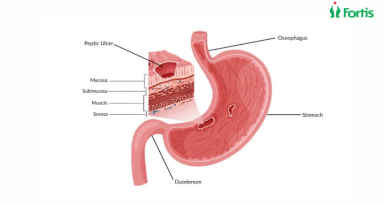 Peptic Ulcer