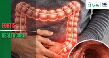 Colon Cancer