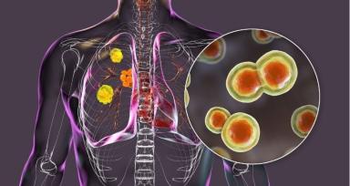 Peripheral Lung Nodules- Why Some Lung Spots Are Harder 