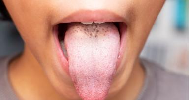 White Tongue- Causes Symptoms Treatment