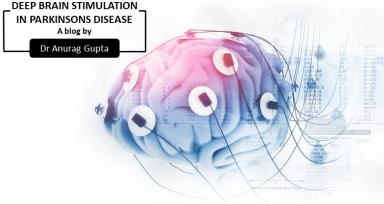 Deep Brain Stimulation In Parkinsons Disease