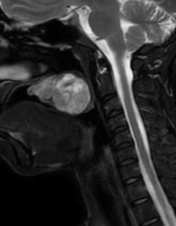 complex head & neck cancer surgery
