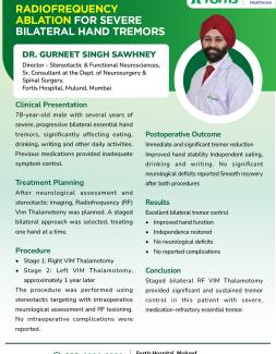 RADIOFREQUENCY ABLATION FOR SEVERE BILATERAL HAND TREMORS