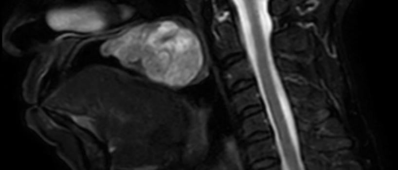 complex head & neck cancer surgery