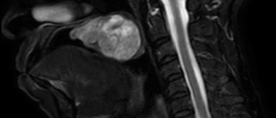 complex head & neck cancer surgery
