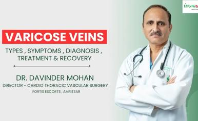 VARICOSE VEINS