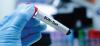 Blood urea nitrogen (BUN) test