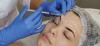 Brow lift