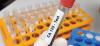 CA 125 test