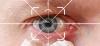 Cataract Surgery