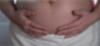 Cervical cerclage