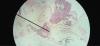 Chorionic villus sampling
