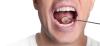Oral Cavity Cancer