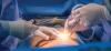 HIPEC Surgery