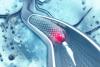 Angioplasty 
