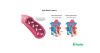 High Blood Pressure (Hypertension)